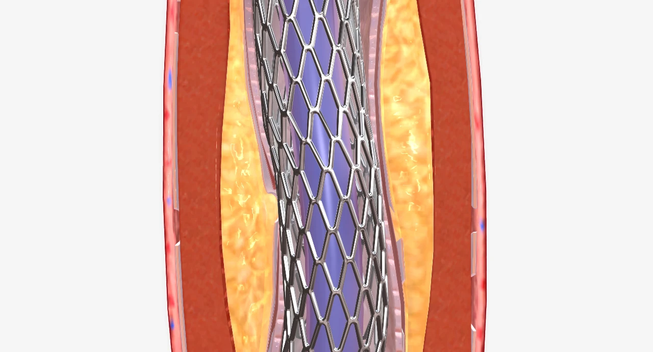 Who Needs a Stent? Lakewood Cardiovascular Consultants